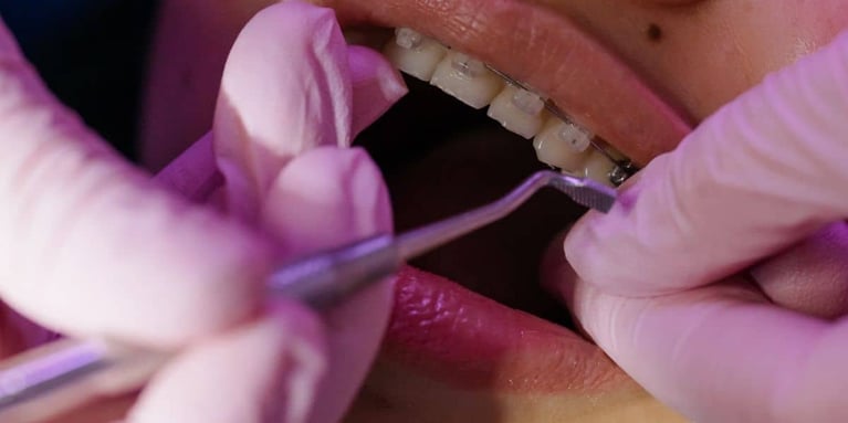 Ortodoncia con extracción de cordales y premolares ¿En qué casos se recomienda?