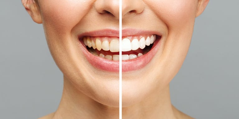 Aclaramiento dental para una sonrisa hermosa y saludable