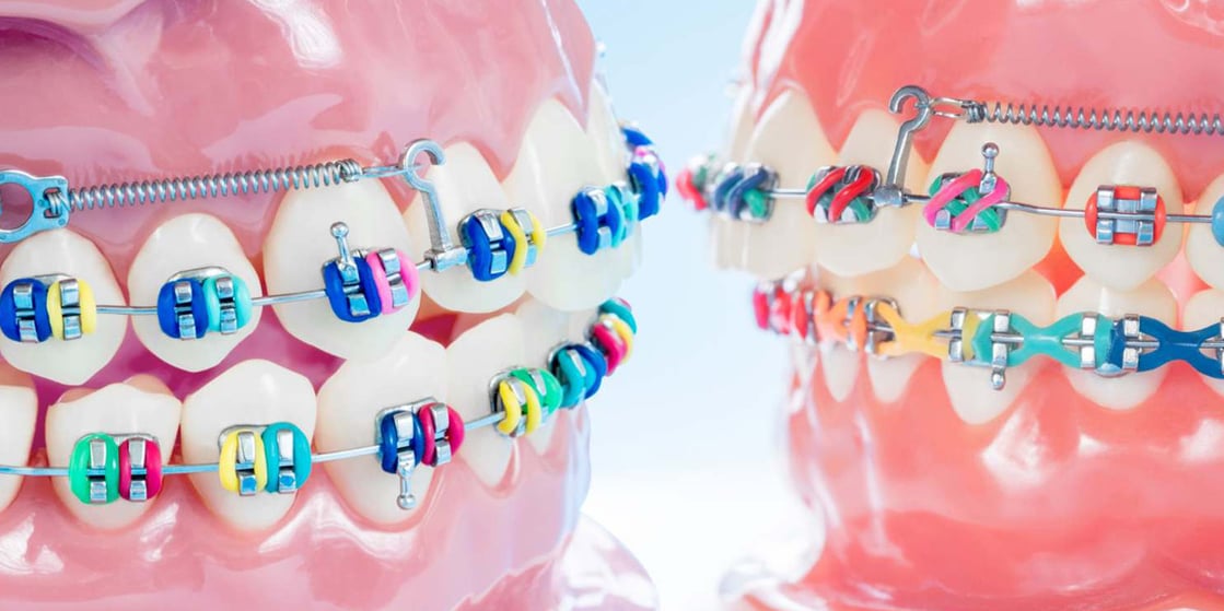 Invisalign, la ortodoncia invisible que mejora tu sonrisa