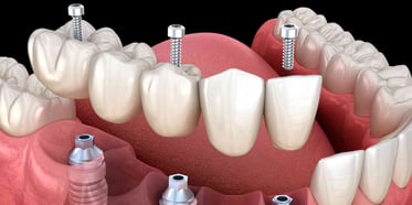 Prótesis dentales: ¿Qué tipos existen y cuál elegir?