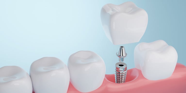 Implantes dentales: Razones por las que son tan populares