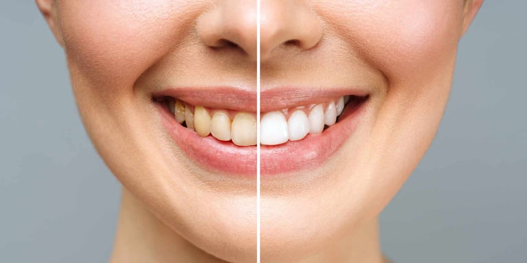 Manchas en los dientes: Tratamientos para eliminarlas