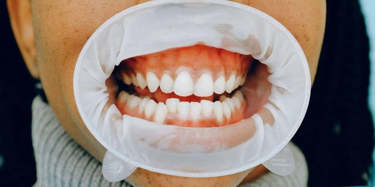 Oclusión dental: Tipos y Ortodoncia