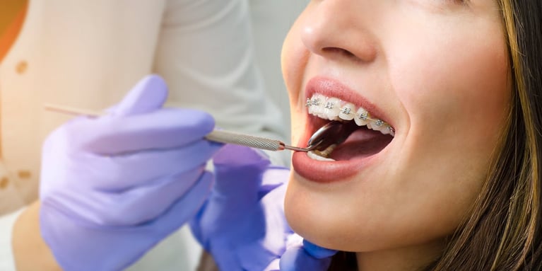 Ortodoncia brackets ¿Cuál es la que más te conviene?
