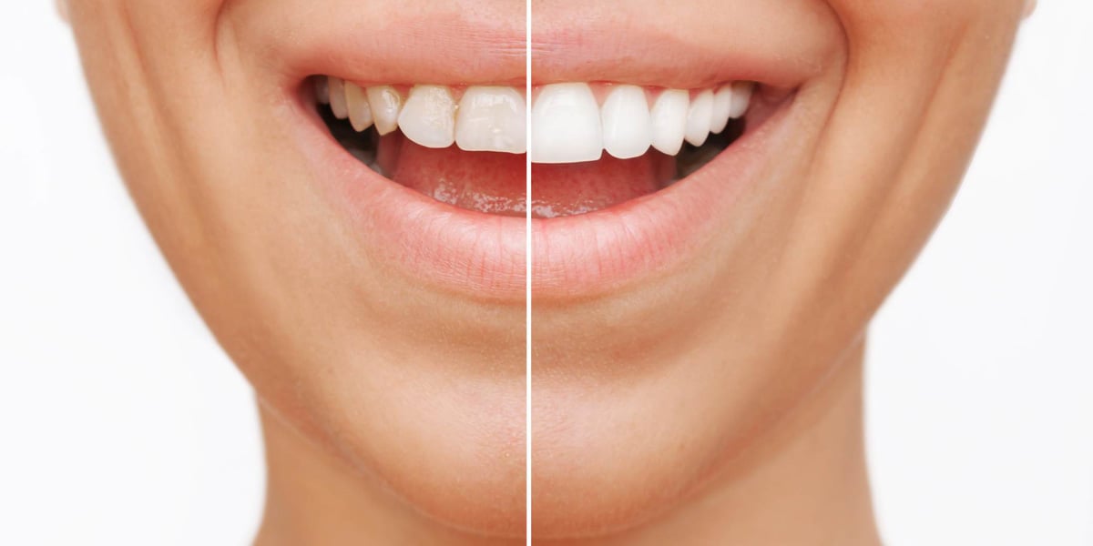 Problemas dentales que corrige un diseño de sonrisa